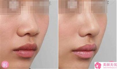 南寧市膨體假體自體隆鼻價格(費用)清單表公布-廣西醫(yī)科大學(xué)美容整形醫(yī)院價格會隨什么而變動