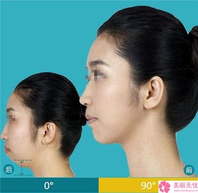 南寧市下巴回縮醫院排行榜十強哪幾個技術棒(南寧市下巴回縮整形醫院)